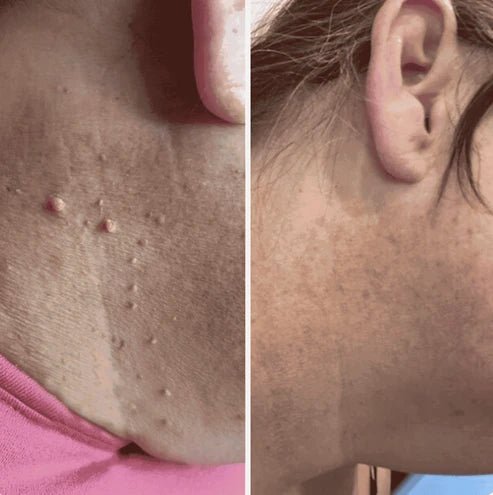 Mecncat Wart Treatment Roll-On: Say Goodbye to Warts and Skin Tags with Precision and Ease - Drteen