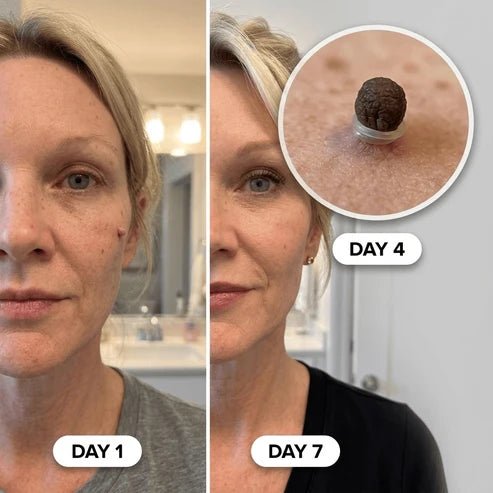 Mecncat Wart Treatment Roll-On: Say Goodbye to Warts and Skin Tags with Precision and Ease - Drteen